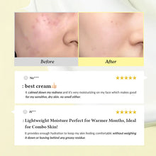 [ Acne Scar & Dark Spot Treatment Kit] – Korean Niacinamide Serum & Soothing Cream for Hyperpigmentation